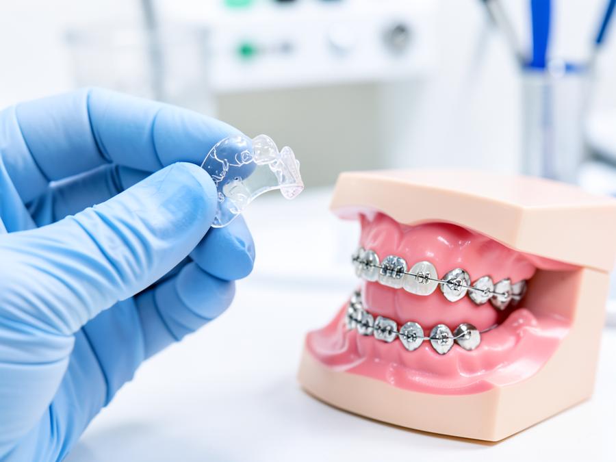 Clear orthodontic aligner tray held beside a dental model fitted with metal braces