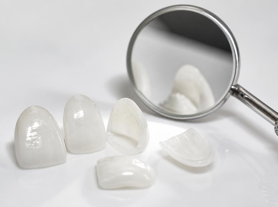 Porcelain veneer shells used for cosmetic smile makeovers